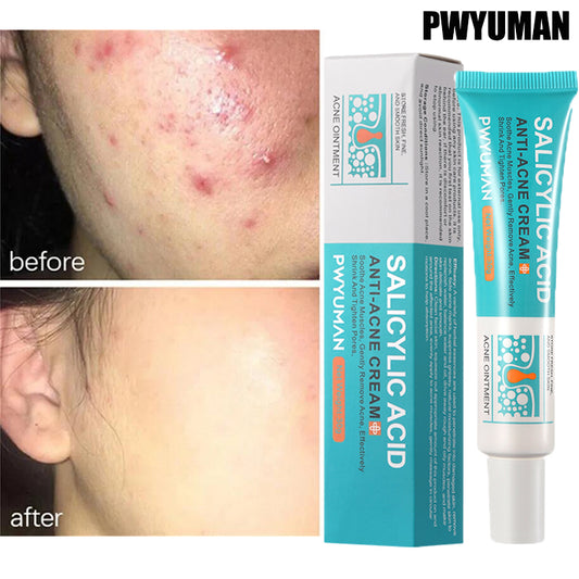 Salicylic Acid Acne Treatment Cream Repair Pimple Spots.