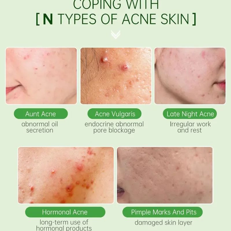 Tea Tree Acne Removal Serum Repair Acne Serum Oil.