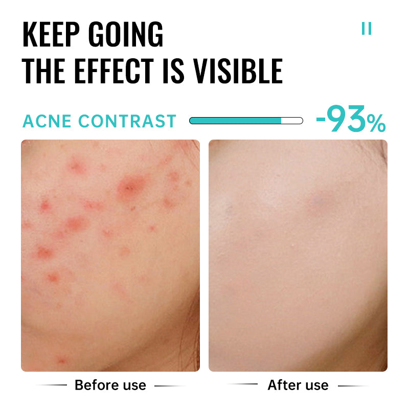 Salicylic Acid Acne Treatment Cream Repair Pimple Spots.