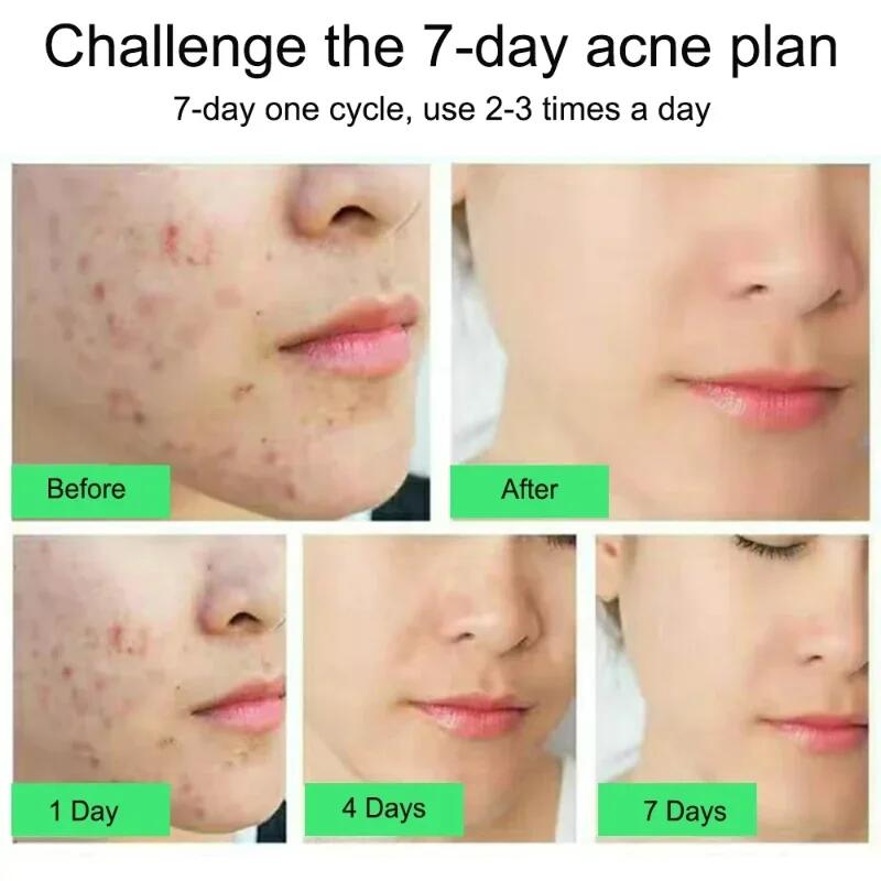 Salicylic Acid Acne Treatment Cream Repair Pimple Spots.