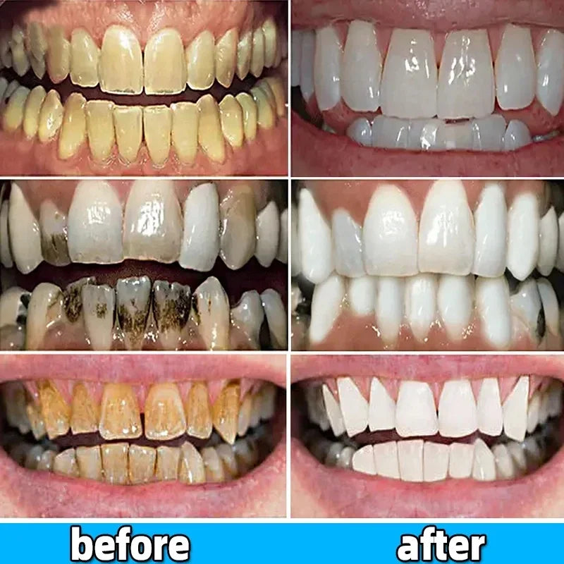 Dental Calculus Remover Bad Breath Removal.