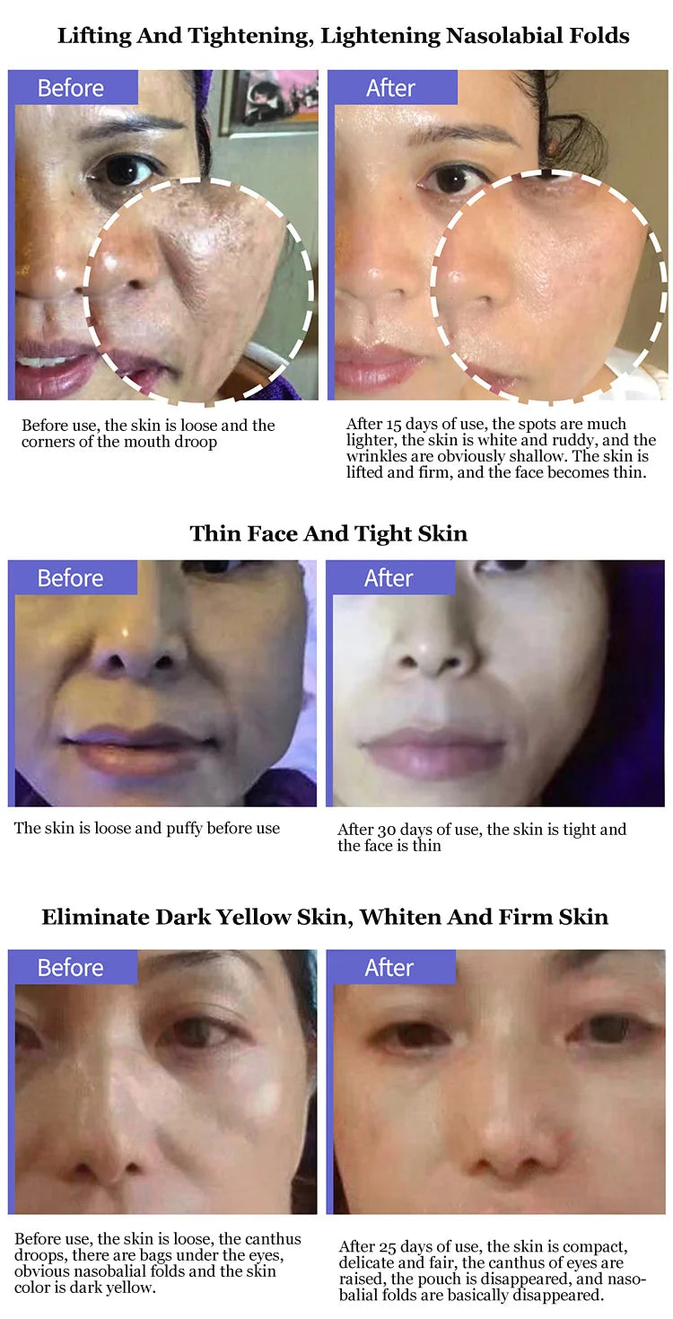 V.Line RF Face Lifting Tightening Wrinkle Removal Dark.