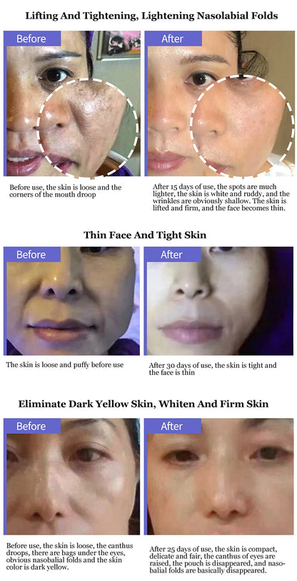 V.Line RF Face Lifting Tightening Wrinkle Removal Dark.