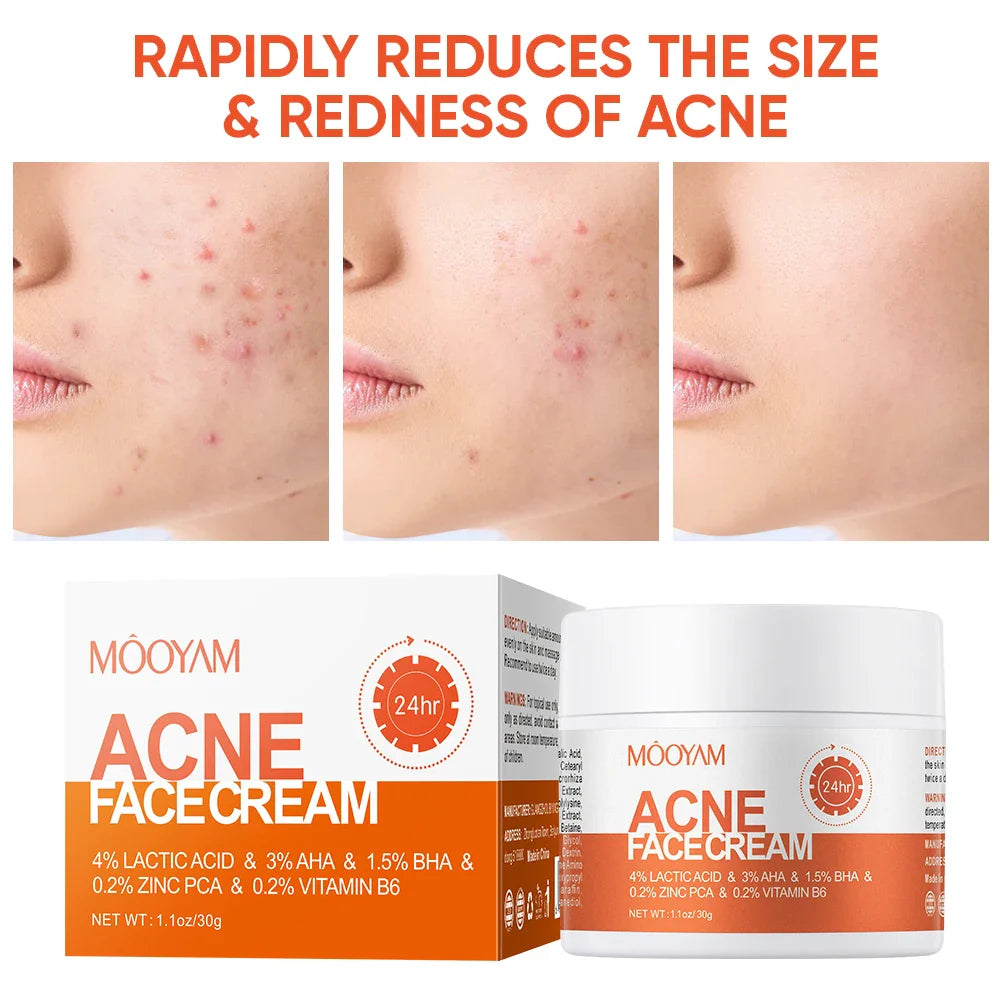 Transform Your Skin with Maigoole Acne Treatment Cream