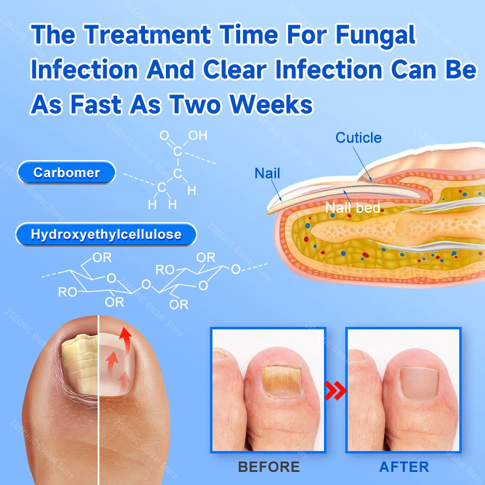 Fungal Nail Laser Device.