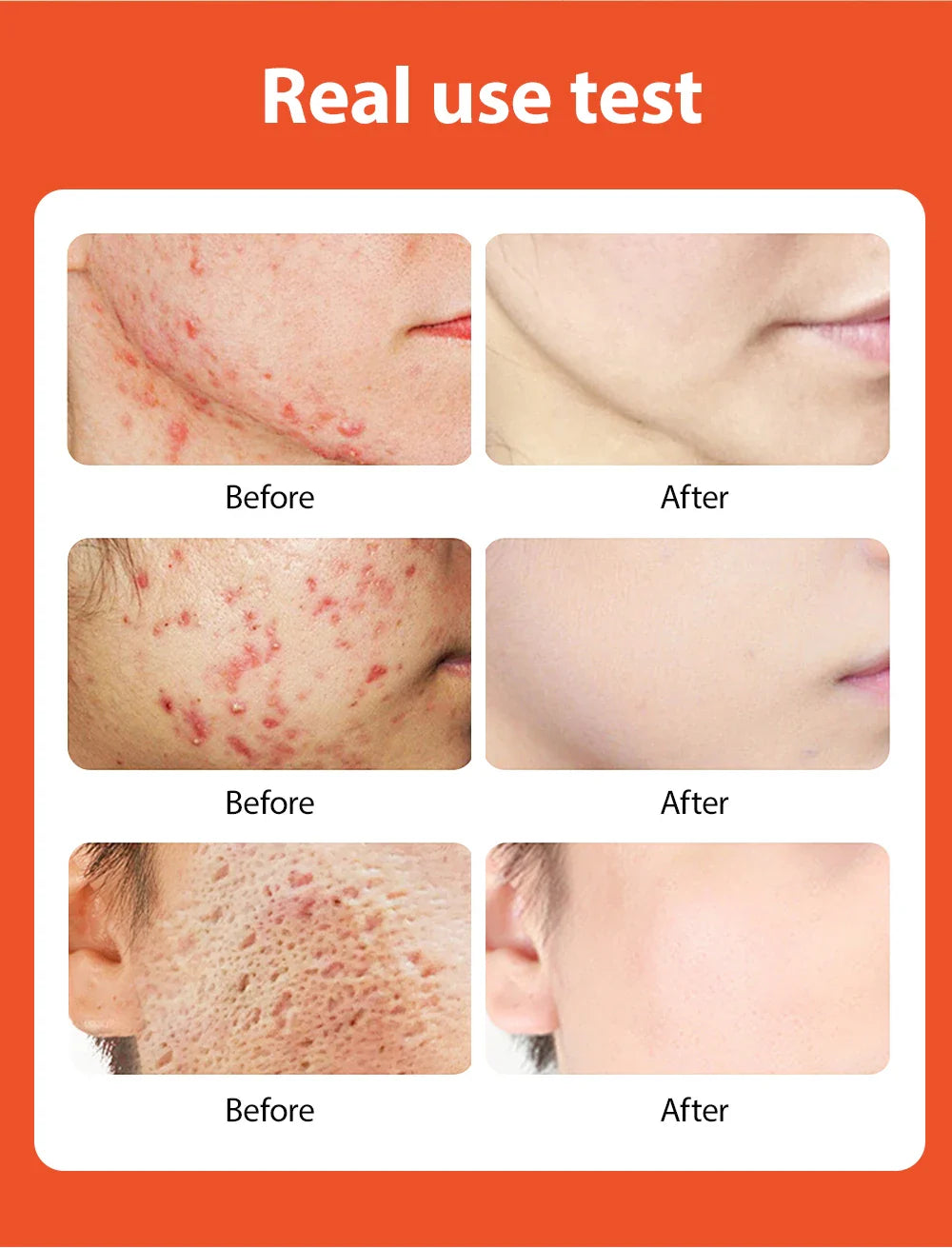 Transform Your Skin with Maigoole Acne Treatment Cream