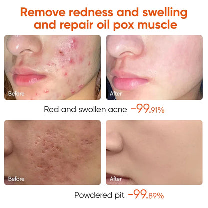 Transform Your Skin with Maigoole Acne Treatment Cream