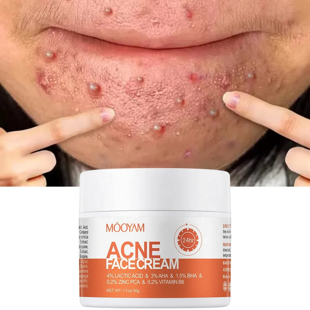 Transform Your Skin with Maigoole Acne Treatment Cream